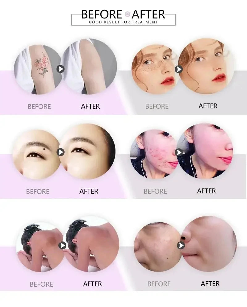 ‌Professional QSwitch NDYag Laser Machine Picosecond Tattoo Pigment Removal Carbon Peeling Facial Cleaning Painless Treatment‌