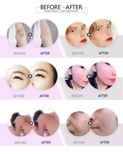 ‌Professional QSwitch NDYag Laser Machine Picosecond Tattoo Pigment Removal Carbon Peeling Facial Cleaning Painless Treatment‌